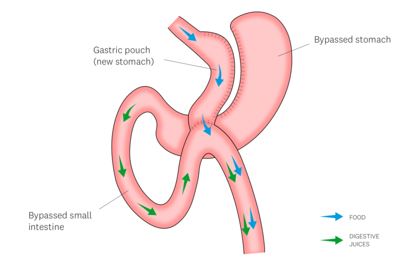 How to Properly Prepare for Gastric Bypass Surgery?